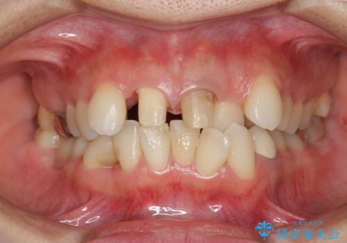 子供の頃にぶつけた前歯 根管治療から行うセラミック治療の治療中