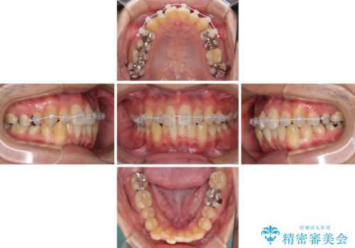 前歯のクロスバイトをインビザラインで矯正治療の治療中