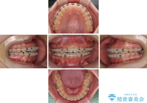 外科矯正は受けたくない 上顎骨拡大による妥協的な受け口治療の治療中