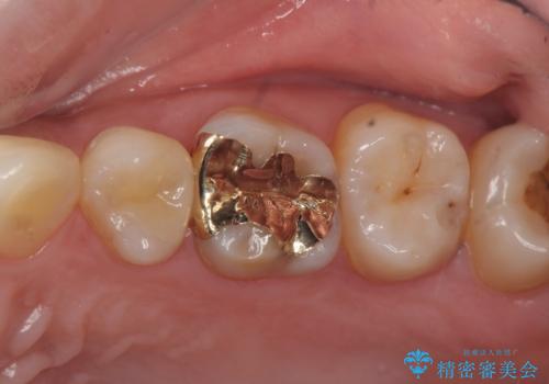 セラミックインレーとゴールドインレーの症例 治療後
