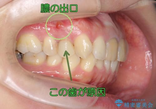 他院の根の治療で一向に治らない、さらに歯根を切ってもらったが良くならないの症例 治療前