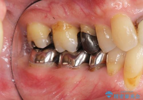 矯正を含む全顎治療の治療前