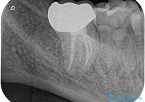 奥の歯茎にニキビみたいなものができた!の治療後