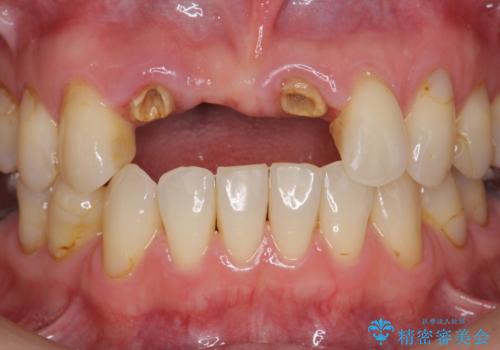 前歯が折れた 前歯部審美セラミックブリッジ治療の治療前