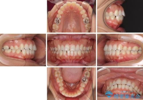 受け口傾向の前歯 すきっ歯の改善の治療前