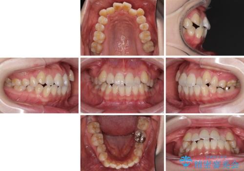 口元の突出感を改善 インビザラインによる非抜歯矯正の治療前