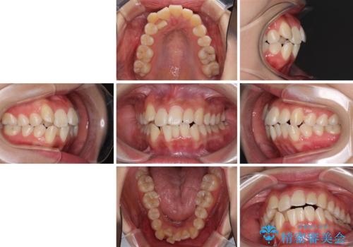 前歯の正中のズレを改善 目立たないワイヤー装置での抜歯矯正の治療前