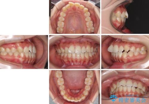 軽微な歯列不正をワイヤー矯正で整えるの治療前
