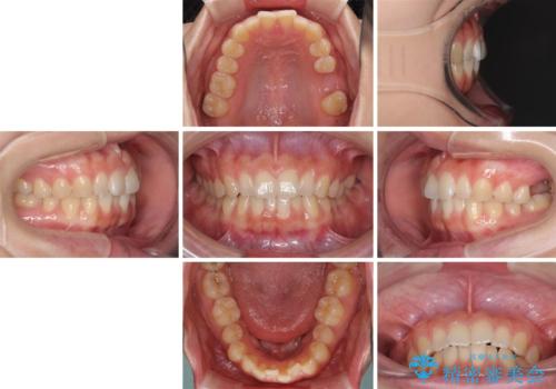 インプラントによる補綴治療とインビザライン矯正の治療前