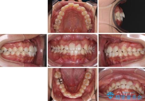 インビザラインが続けられない ワイヤー装置での矯正治療の治療前