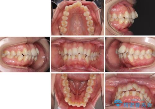 口元をスッキリと ワイヤー装置による抜歯矯正の治療前