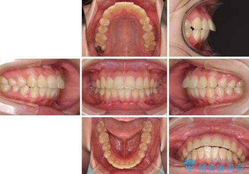 部分矯正で出っ歯になった　出っ歯改善の抜歯矯正の治療前