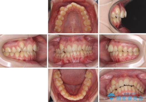 八重歯を短期間で改善 ワイヤー装置による抜歯矯正の治療前
