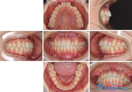 前歯のクロスバイト インビザラインによる矯正治療の治療前