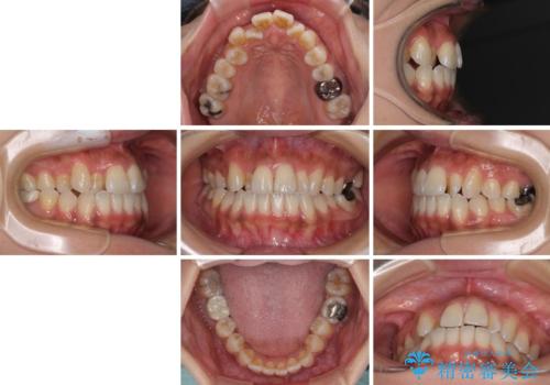 【モニター】幅の狭い上顎歯列 骨幅を拡大する矯正治療の治療前