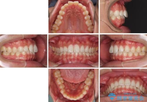 細かい隙間にものがはさまる インビザラインによる矯正治療の治療前