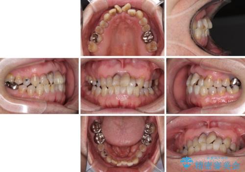上顎の狭窄歯列 インビザラインによる拡大矯正の治療前