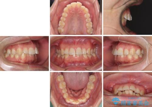 ディープバイトと叢生を解消 インビザライン矯正の治療前