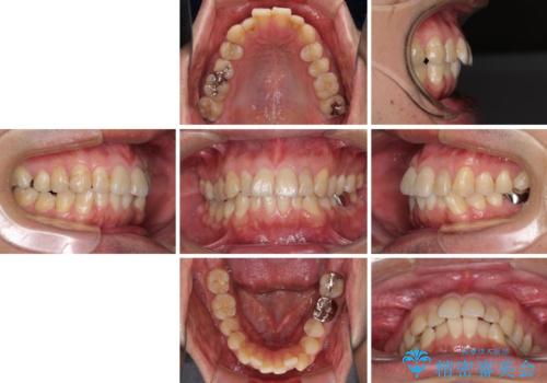 前歯のデコボコと下顎の八重歯 インビザラインによる矯正治療の治療前