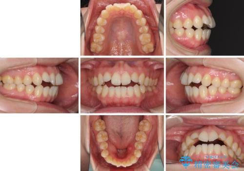 前歯の叢生とオープンバイト インビザラインでの矯正治療の治療前