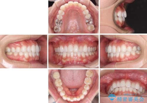 軽度の叢生をインビザライン・ライトで解消の治療前