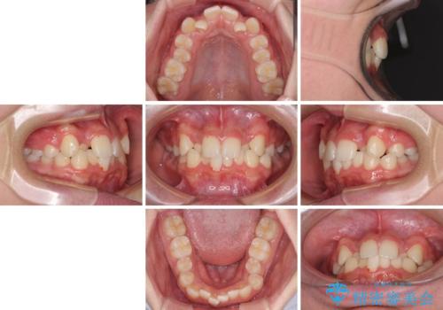 中学生のワイヤー矯正 クロスバイトを短期間で改善の治療前