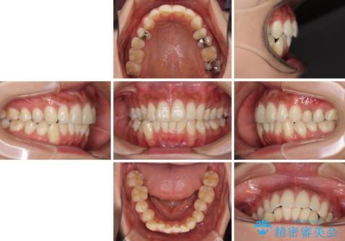 八重歯の再矯正 インビザラインでストレスなく矯正治療の治療前