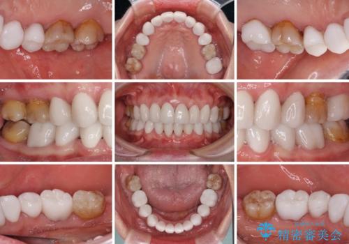出っ歯を改善した後に真っ白な歯に 矯正歯科治療と審美歯科治療の治療後