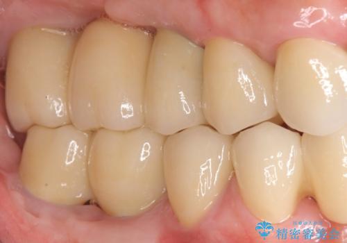 インプラント治療で達成するしっかりと食事できる噛み合わせの症例 治療後