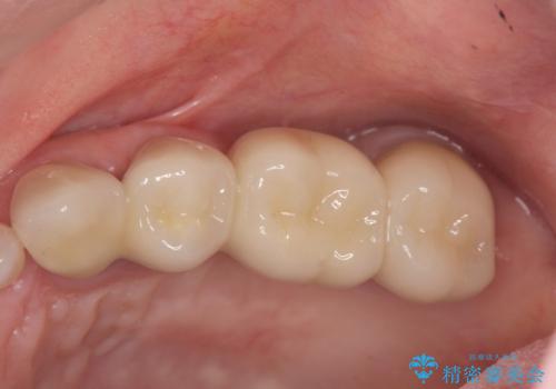 歯周病 ブリッジ補綴の治療後
