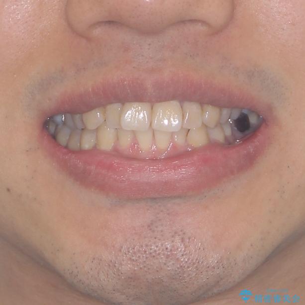 前歯のデコボコと下顎の八重歯　インビザラインによる矯正治療の治療前（顔貌）