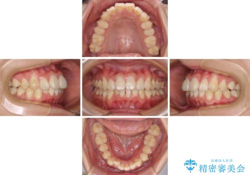 上下前歯の叢生をインビザラインできれいにの治療中