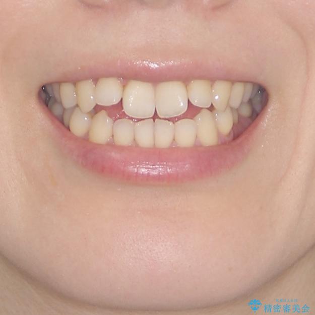 前歯の叢生とオープンバイト　インビザラインでの矯正治療の治療前（顔貌）