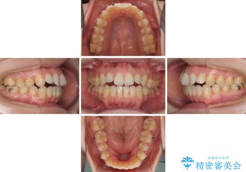 前歯の叢生とオープンバイト インビザラインでの矯正治療の治療中