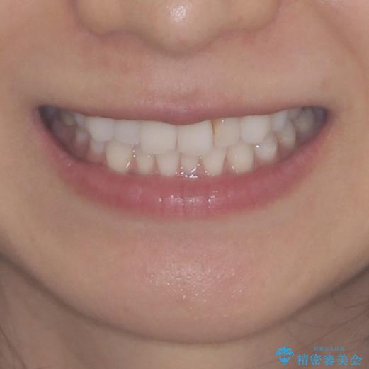 軽度の叢生をインビザライン・ライトで解消の治療前(顔貌)