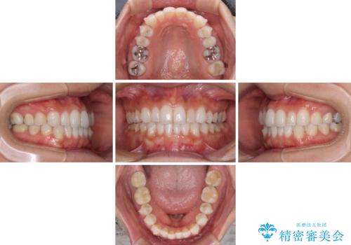 軽度の叢生をインビザライン・ライトで解消の治療中