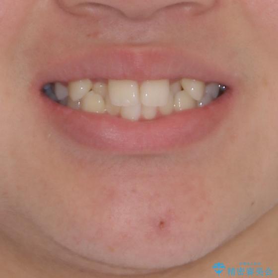 中学生のワイヤー矯正 クロスバイトを短期間で改善の治療前(顔貌)