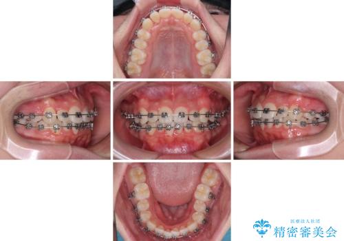 中学生のワイヤー矯正 クロスバイトを短期間で改善の治療中