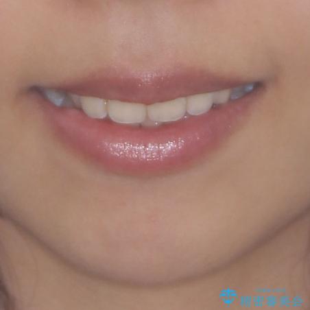 八重歯の再矯正 インビザラインでストレスなく矯正治療の治療前(顔貌)