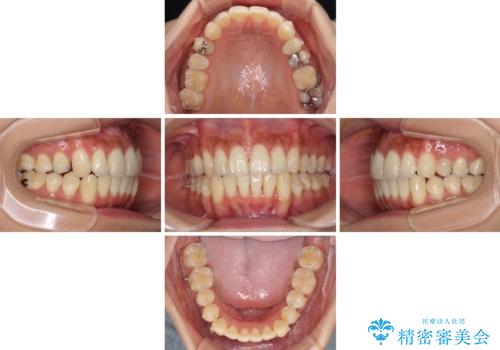 八重歯の再矯正 インビザラインでストレスなく矯正治療の治療中