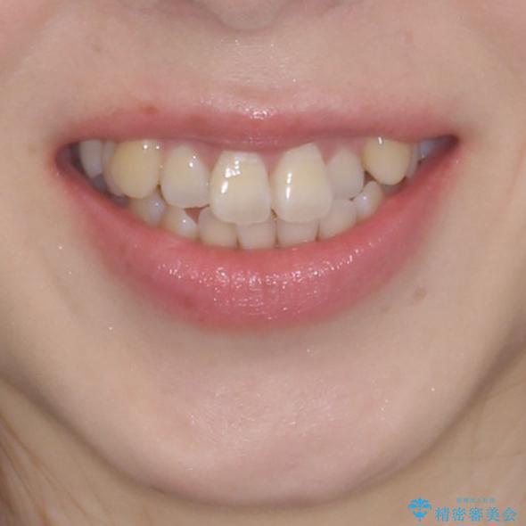 口元の突出感を改善　インビザラインによる非抜歯矯正の治療前（顔貌）