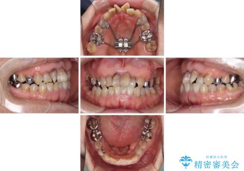 上顎の狭窄歯列 インビザラインによる拡大矯正の治療中