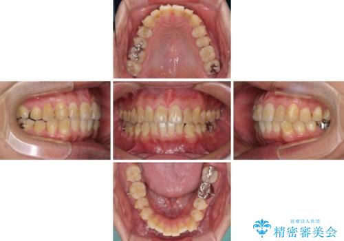 前歯のデコボコと下顎の八重歯 インビザラインによる矯正治療の治療中