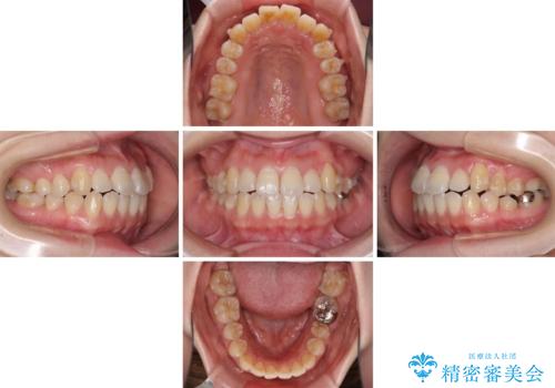 口元の突出感を改善 インビザラインによる非抜歯矯正の治療中
