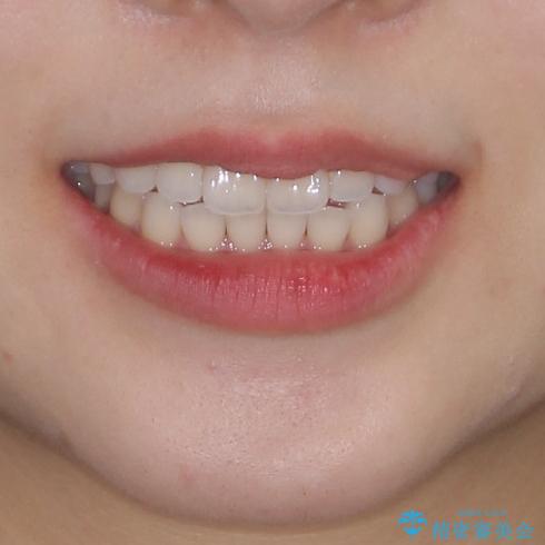 インビザライン・ライトにより後戻りの再矯正の治療前(顔貌)