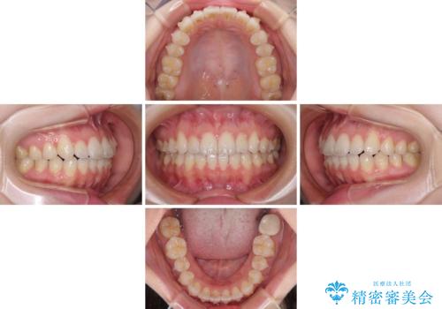 インビザライン・ライトにより後戻りの再矯正の治療中