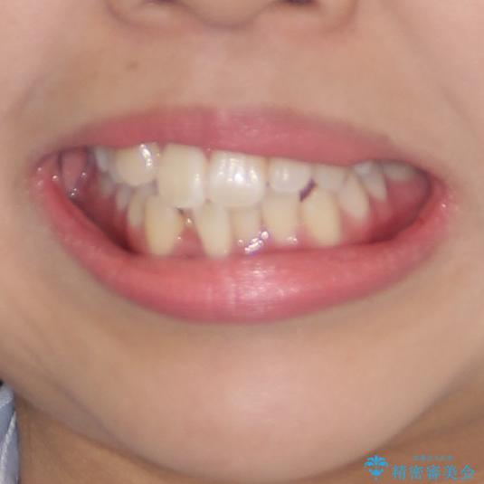 前歯の正中のズレを改善　目立たないワイヤー装置での抜歯矯正の治療前（顔貌）