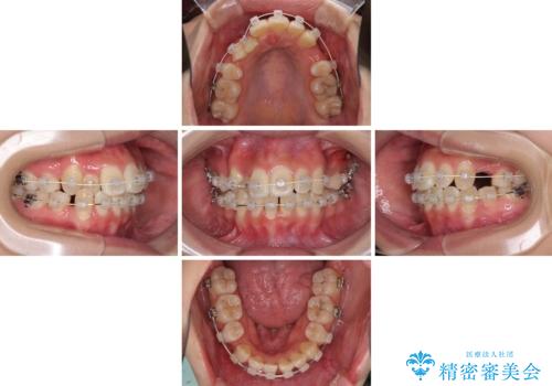 前歯の正中のズレを改善　目立たないワイヤー装置での抜歯矯正の治療中