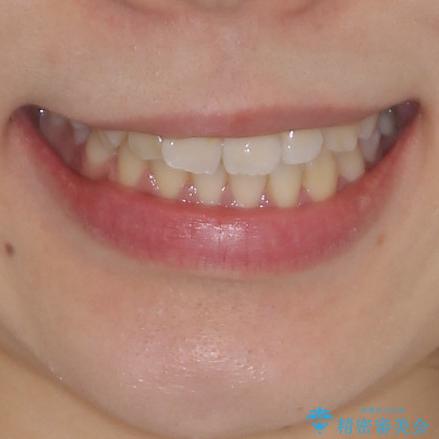 軽微な歯列不正をワイヤー矯正で整えるの治療前（顔貌）