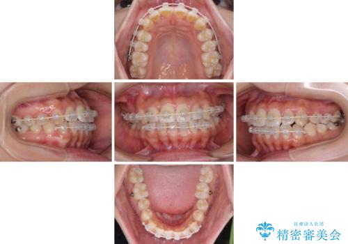 軽微な歯列不正をワイヤー矯正で整えるの治療中